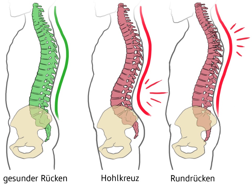 Drei grafische Abbildungen von Wirbelsäulen. Gesunder Rücken in grün dargestellt, Hohlkreuz und Rundrücken in Rot.