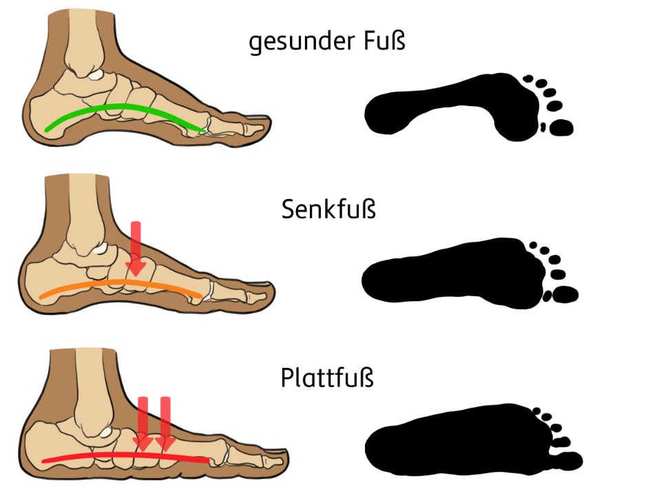 Drei grafische Abbildungen von Füßen. Gesunder Fuß in grün dargestellt, Senkfuß und Plattfuß in rot. Daneben der jeweilige Fußabdruck in schwarz. 