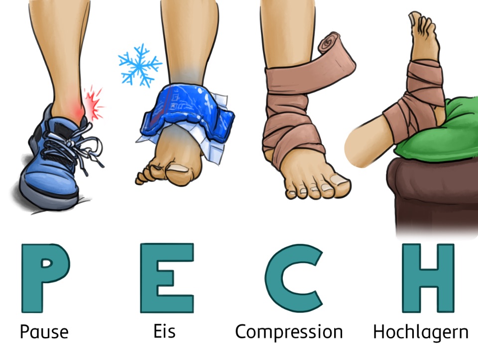 Illustrierte Erklärung der PECH-Regel: Pause–Eis–Compression–Hochlagern - beim P ist ein umknicksender Fuß, beim E ein Fuß mit Eisbeutel, beim C ein fuß mit Compression und beim H ein hochgelagerter Fuß abgebildet.