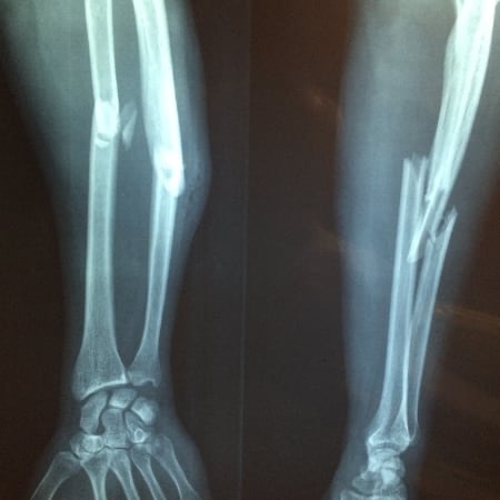 Röntgenbild eines Knochenbruchs