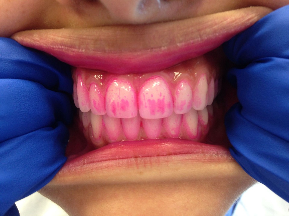 Eine Plaquetablette macht den Zahnbelag sichtbar.