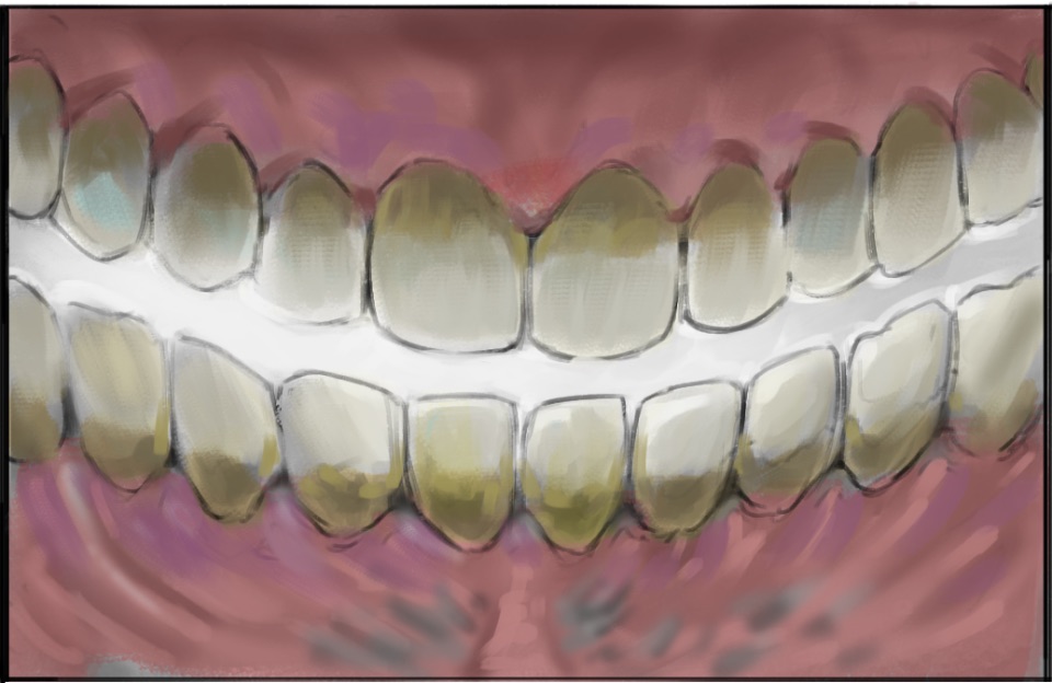 Bild aus dem Inneren des Mundes: Zahnstein ist als gelbliche Verfärbung im obeneren Bereich der Zähne zu erkennen.