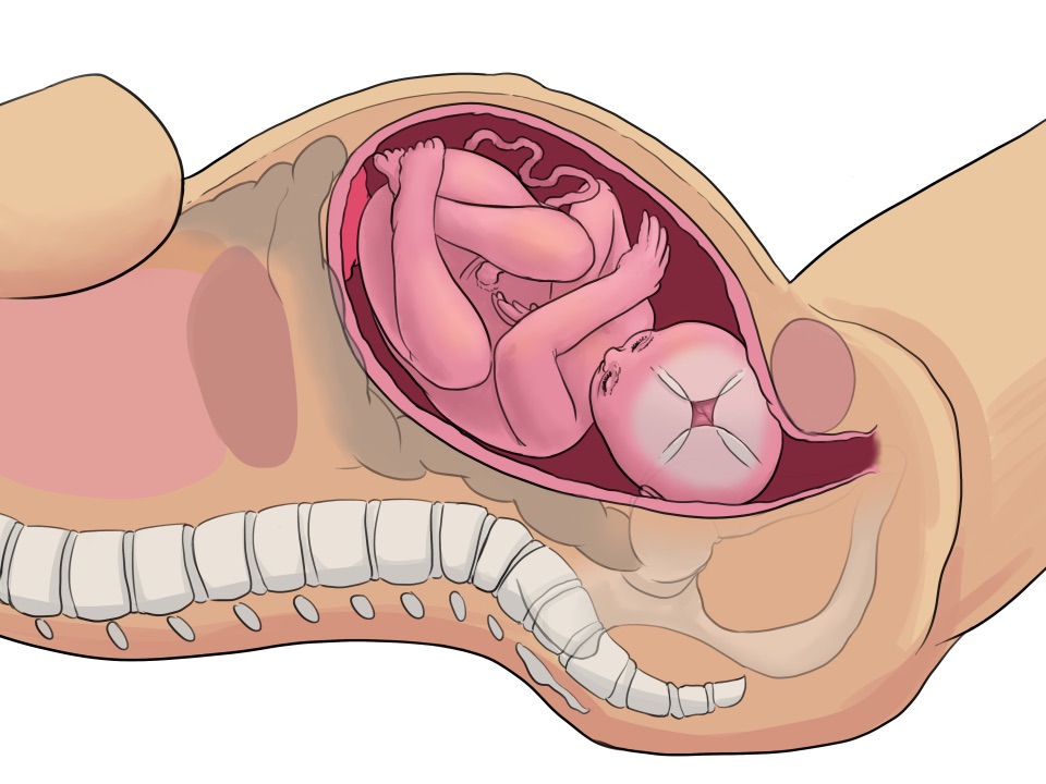 Illustiert, die Verschiebung der Fontanellen im Geburtskanal
