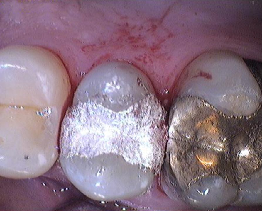 Zahnfüllungen aus Amalgam
